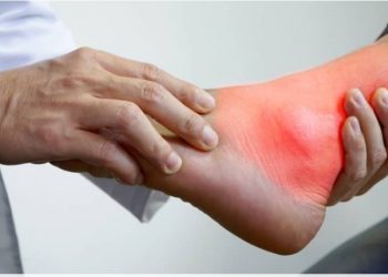 Biar Asam Urat Ngak Kumat, Hindari Konsumsi Makanan ini